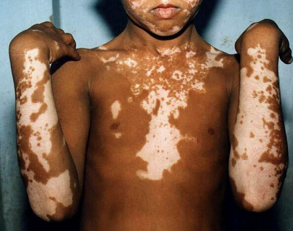 vitiligo_3_030116